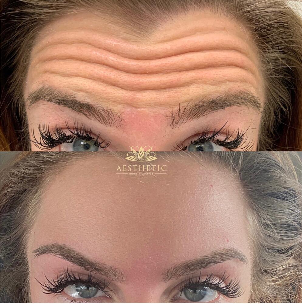 Botox Before & After Image