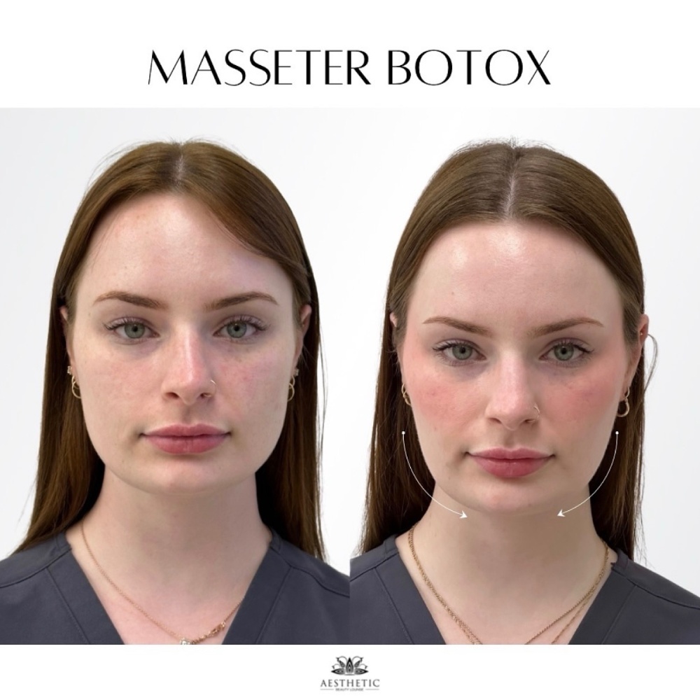 Botox Before & After Image
