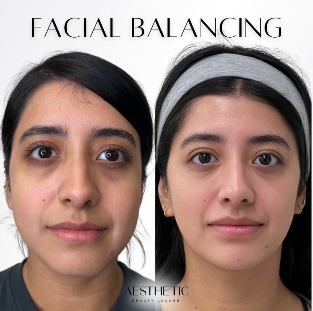 Facial Balancing Before & After Image