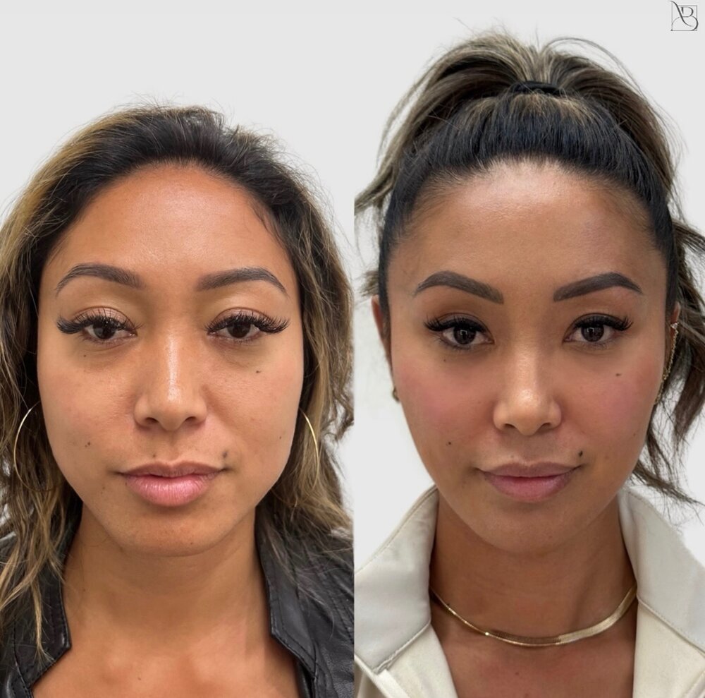Facial Balancing Before & After Image