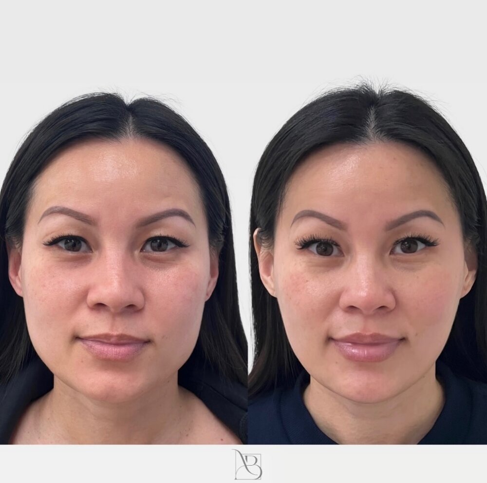 Facial Balancing Before & After Image