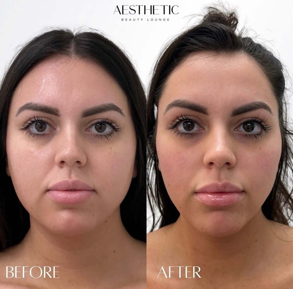 Facial Balancing Before & After Image