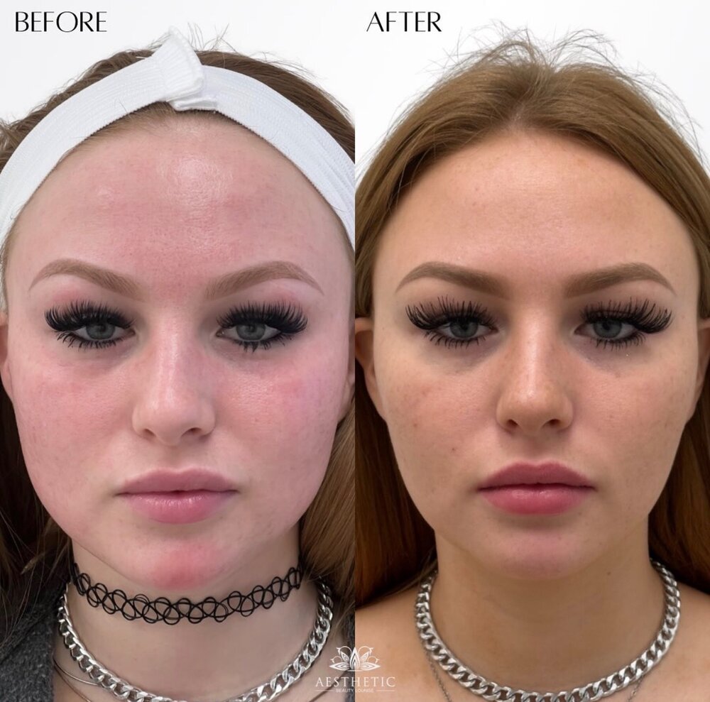 Facial Balancing Before & After Image