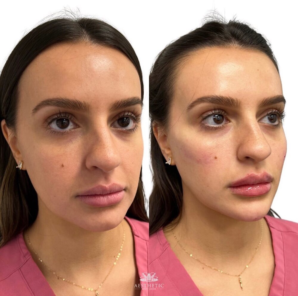 Facial Balancing Before & After Image