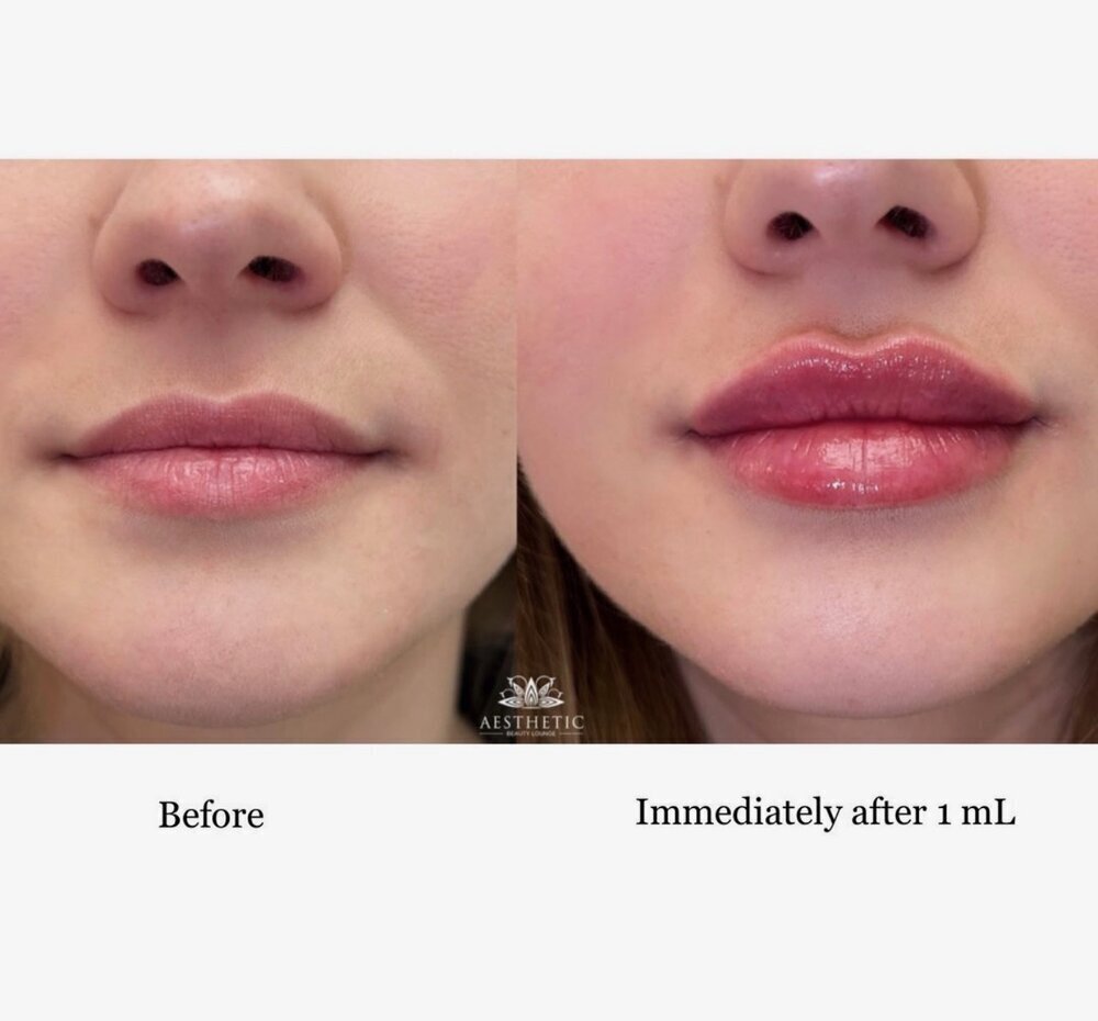 Lip Filler Before & After Image