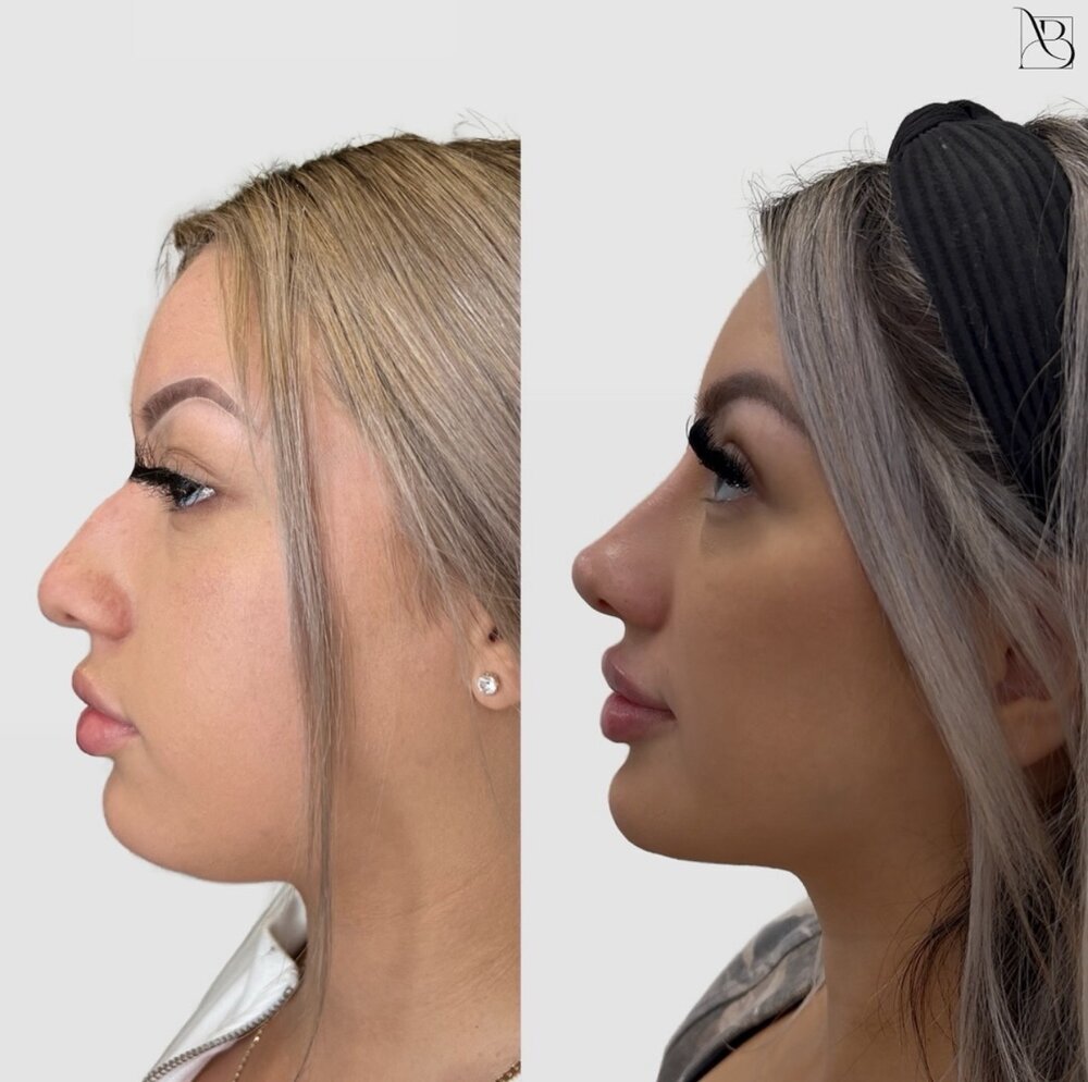 profile balance Before & After Image