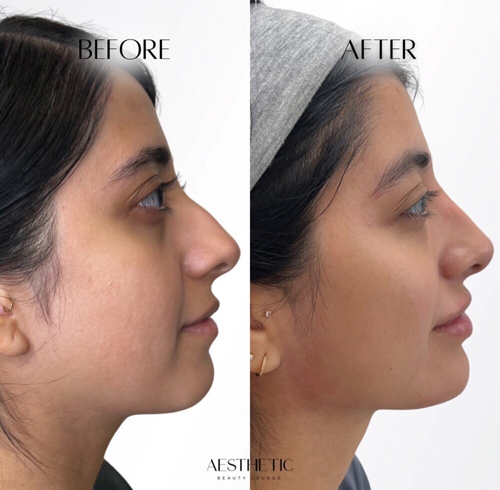 profile balance Before & After Image