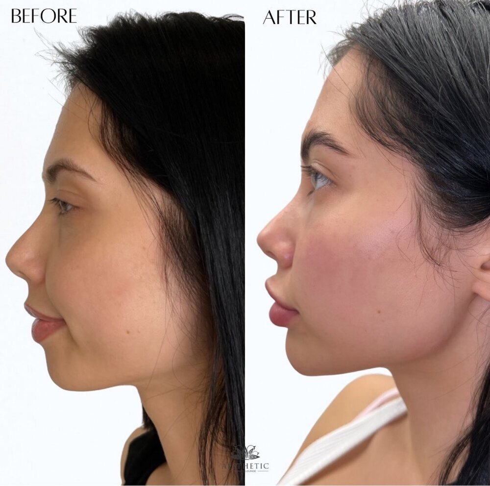profile balance Before & After Image