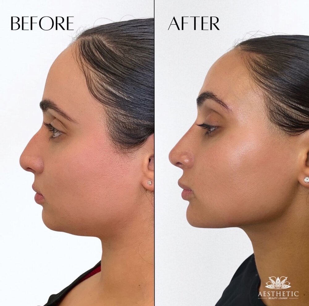 profile balance Before & After Image