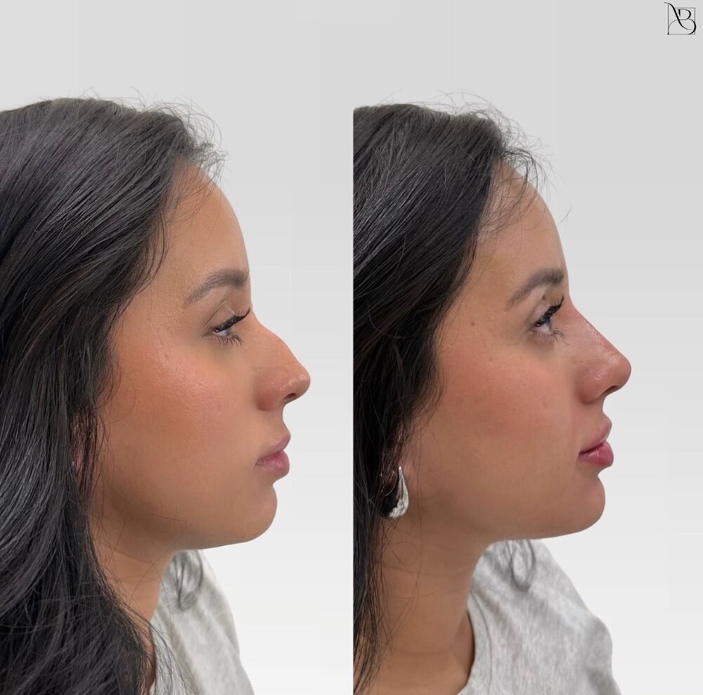 profile balance Before & After Image