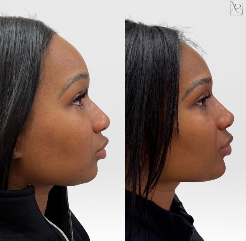 profile balance Before & After Image