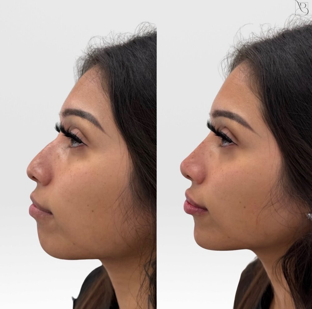 profile balance Before & After Image