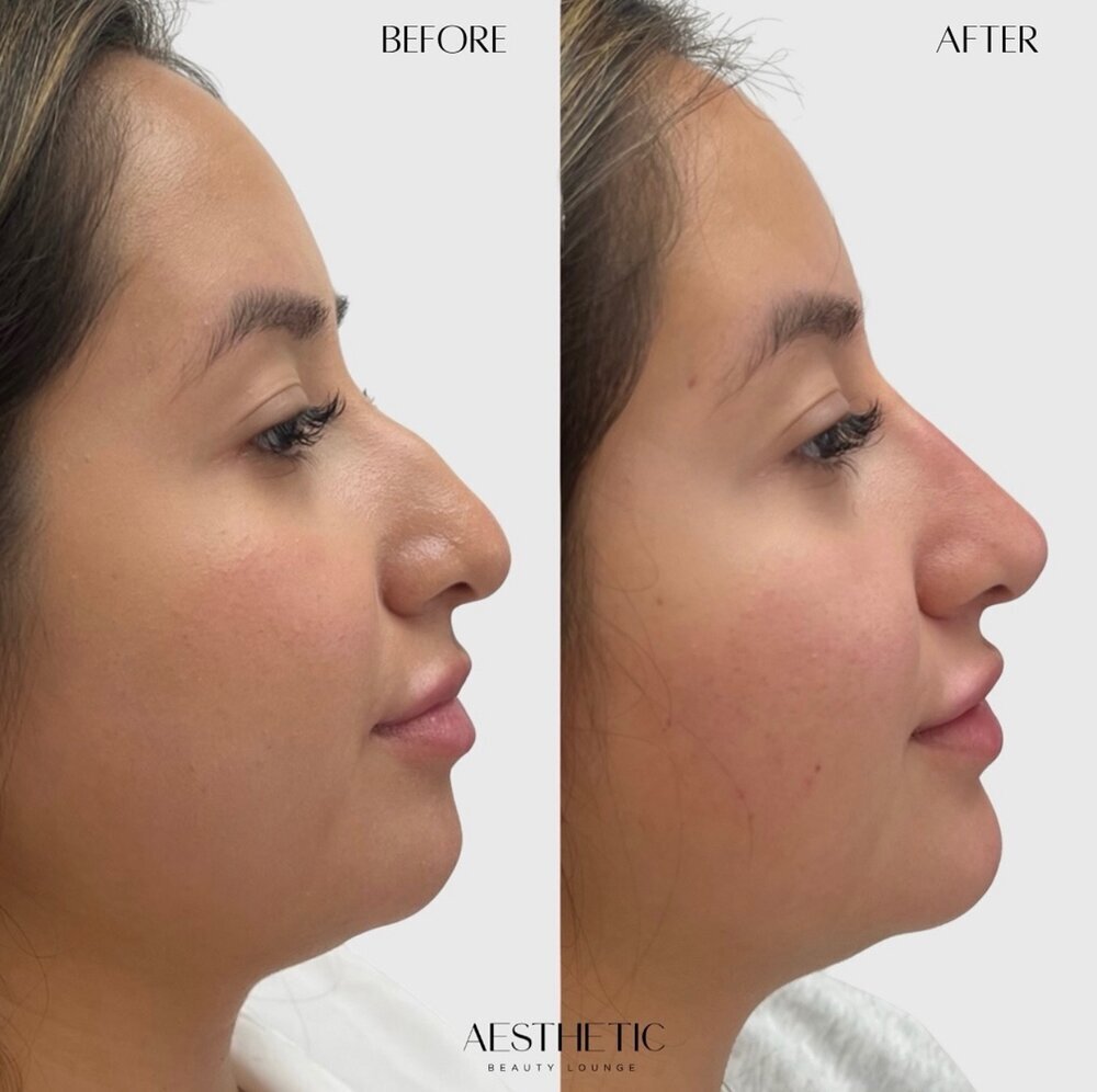 profile balance Before & After Image