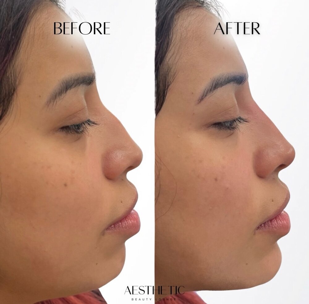 Profile Balance Before & After Image