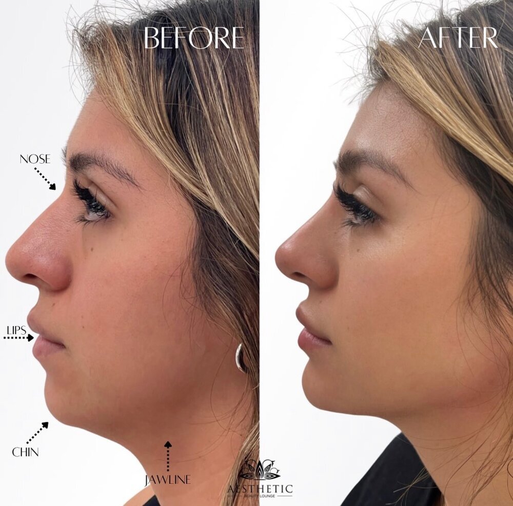 Profile Balance Before & After Image