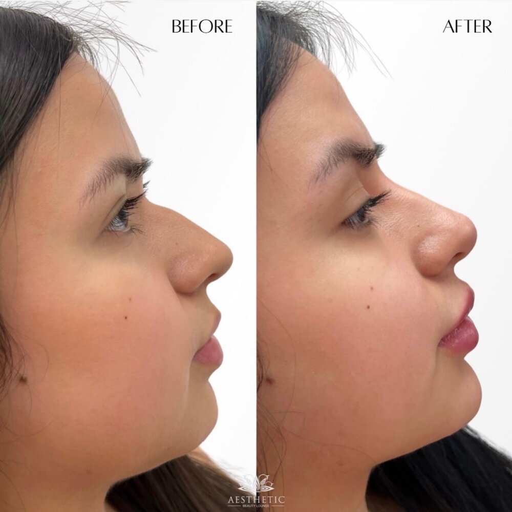 Profile Balance Before & After Image