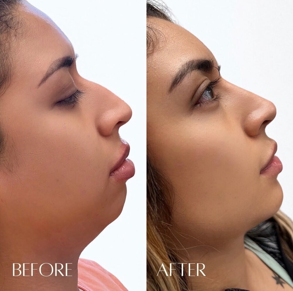 Profile Balance Before & After Image