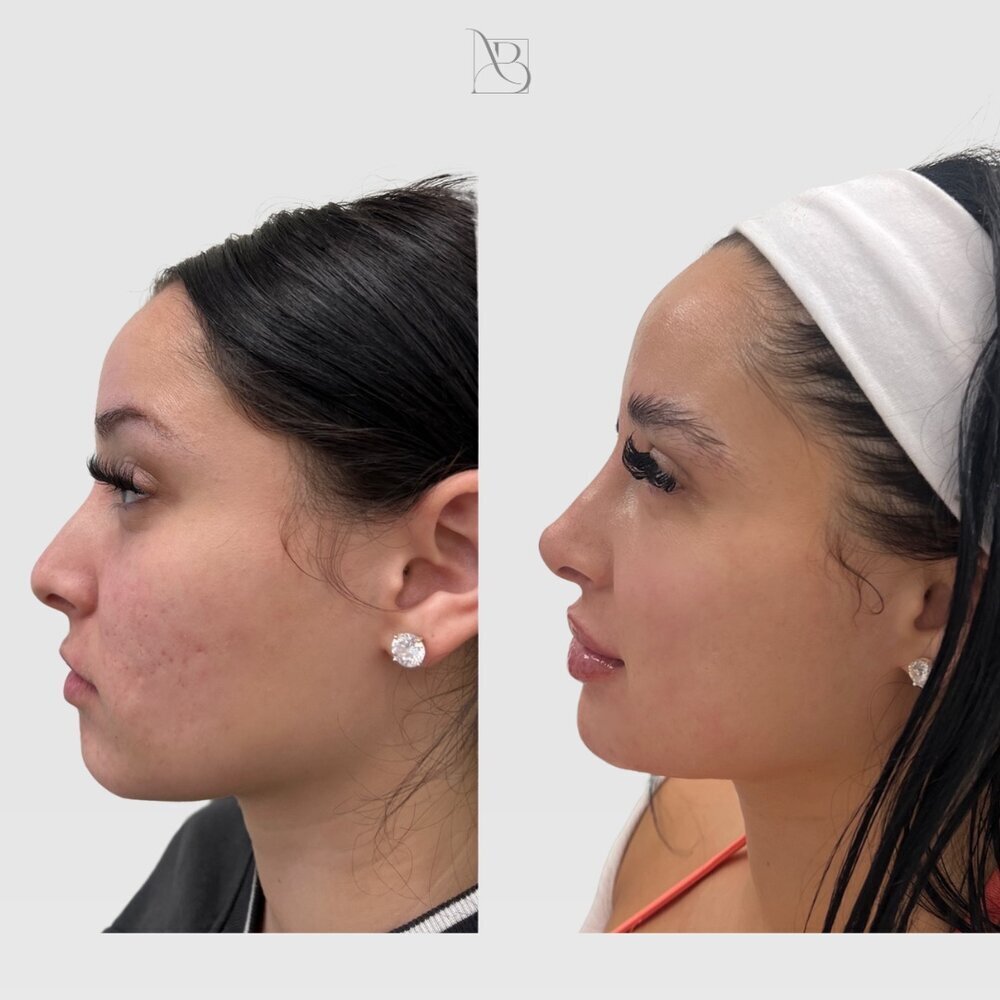 Profile Balance Before & After Image