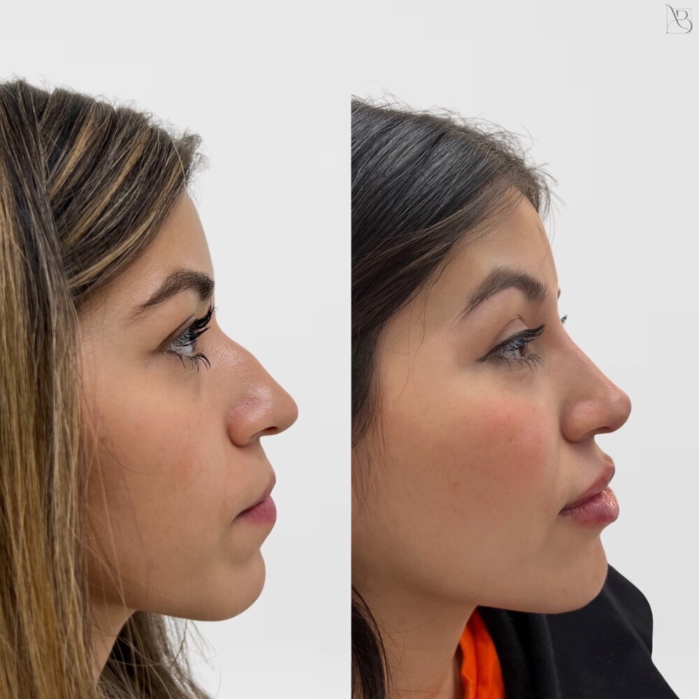 Profile Balance Before & After Image