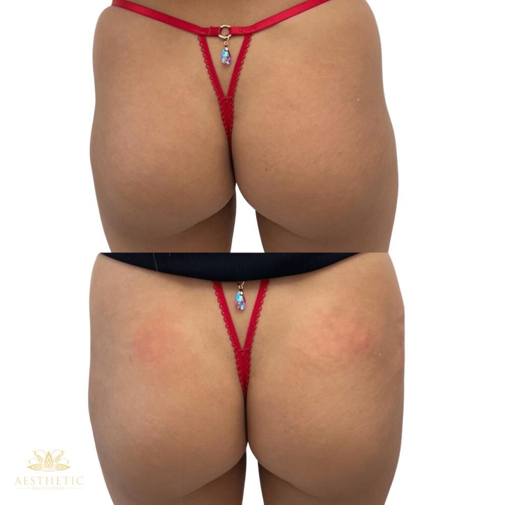 Sculptra BBL Before & After Image