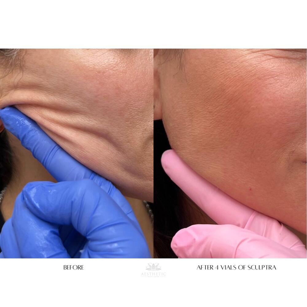 Sculptra Face Before & After Image
