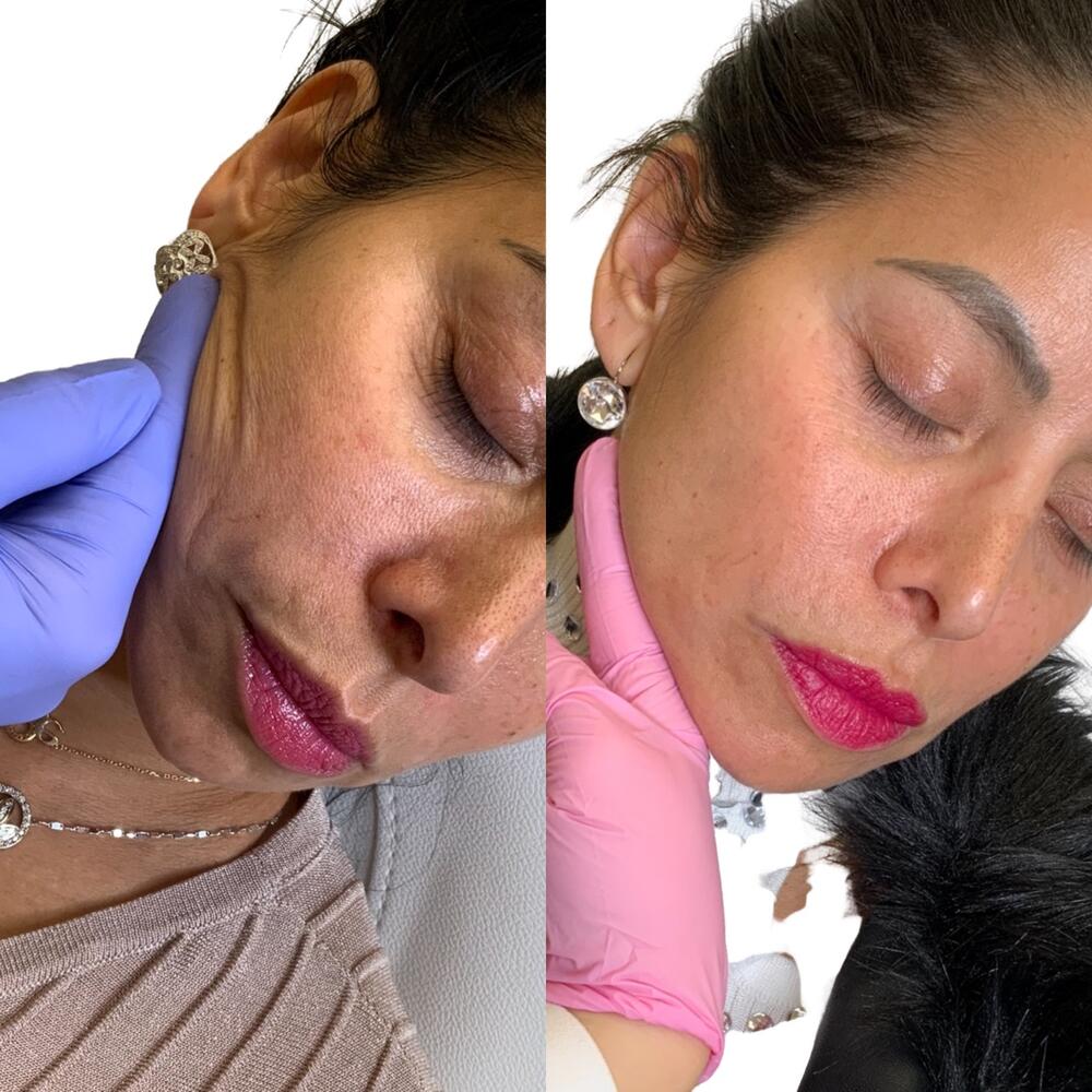 Sculptra Face Before & After Image