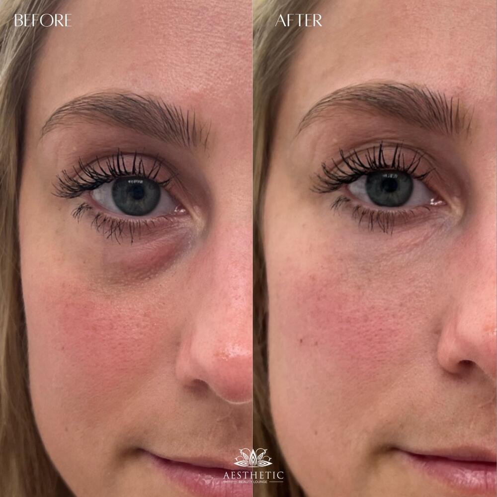 Under Eye Filler Before & After Image