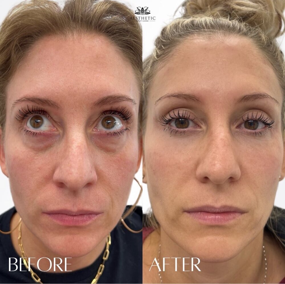 Under Eye Treatments Before & After Image