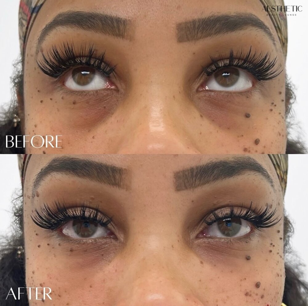Under Eye Treatments Before & After Image