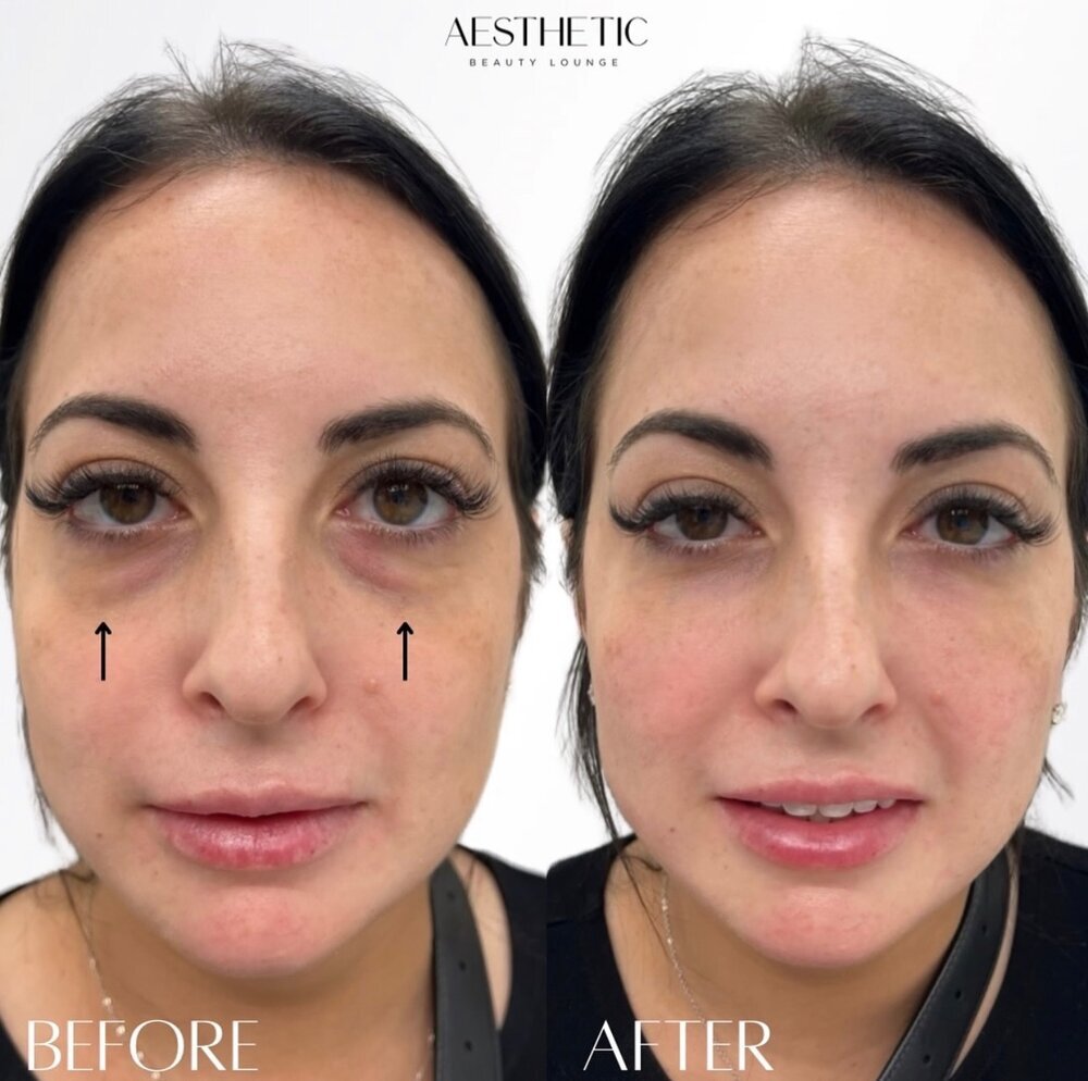 Under Eye Treatments Before & After Image