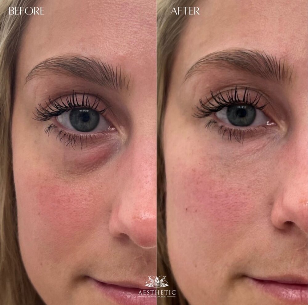 Under Eye Treatments Before & After Image