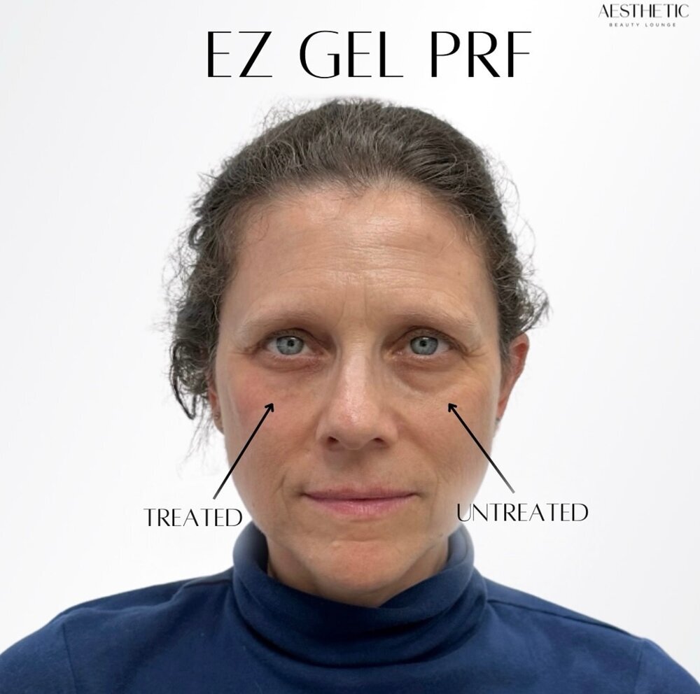 Under Eye Treatments Before & After Image