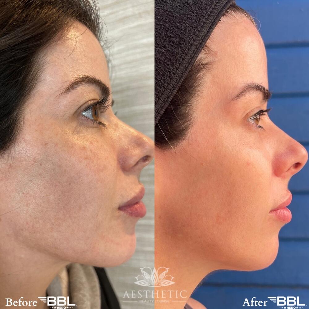 Before After BBL Laser Highland Park Aesthetic Beauty Lounge