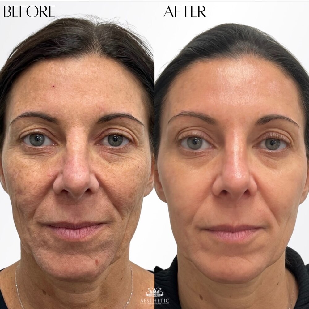 BBL Moxi Before & After Image