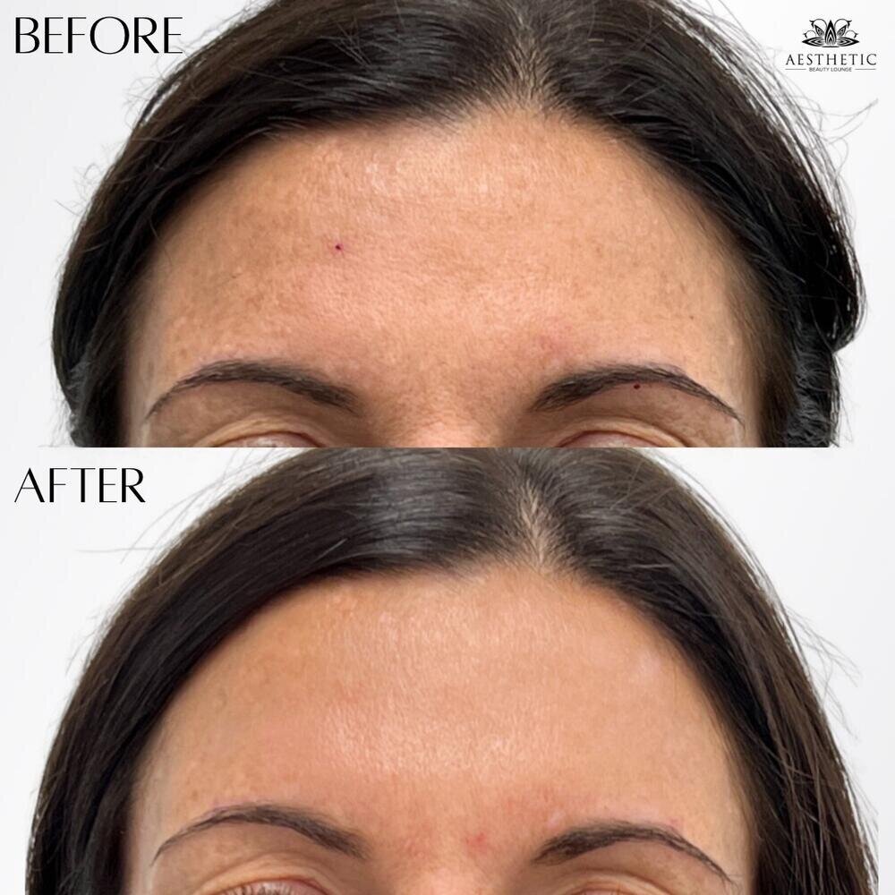 BBL Moxi Before & After Image