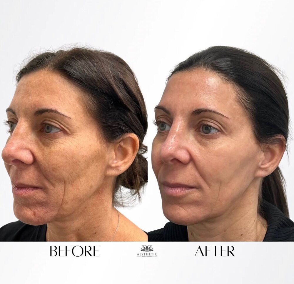 BBL Moxi Before & After Image