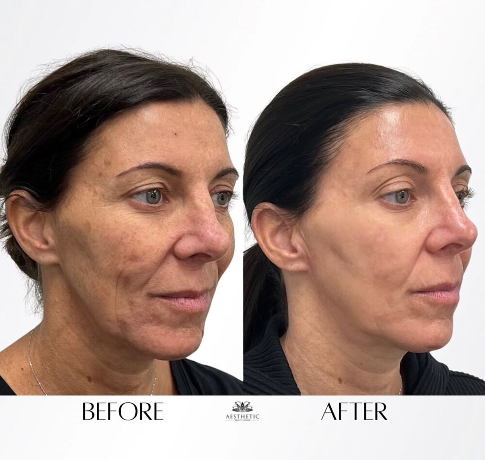 BBL Moxi Before & After Image