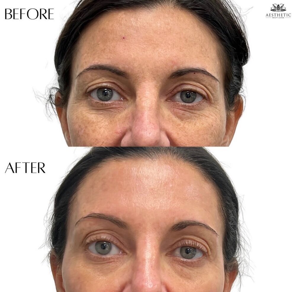 BBL Moxi Before & After Image