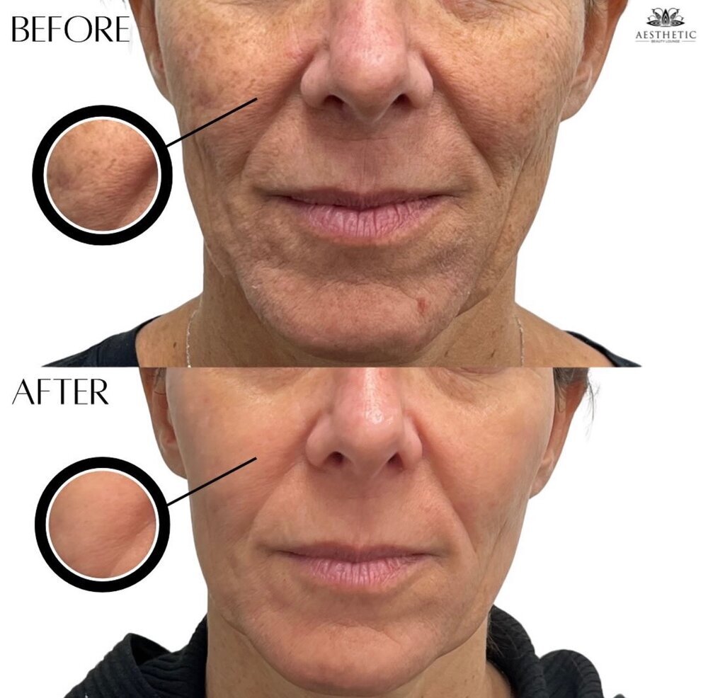 BBL Moxi Before & After Image