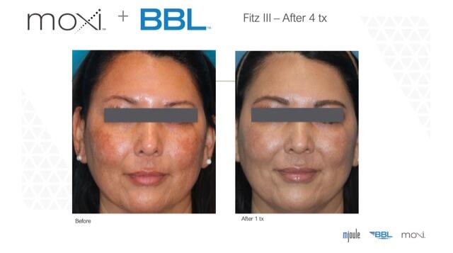 Moxi BBL Before & After Image