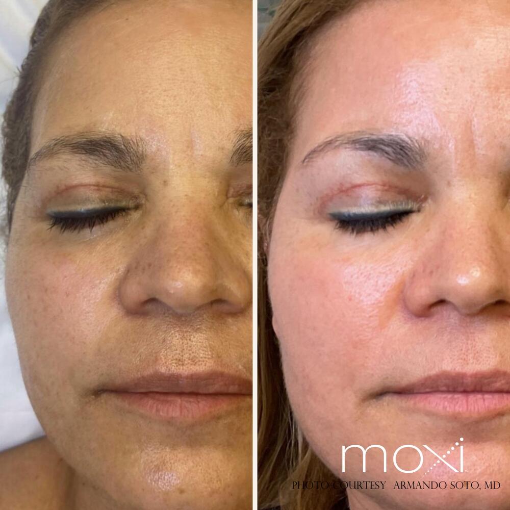 Moxi BBL Before & After Image