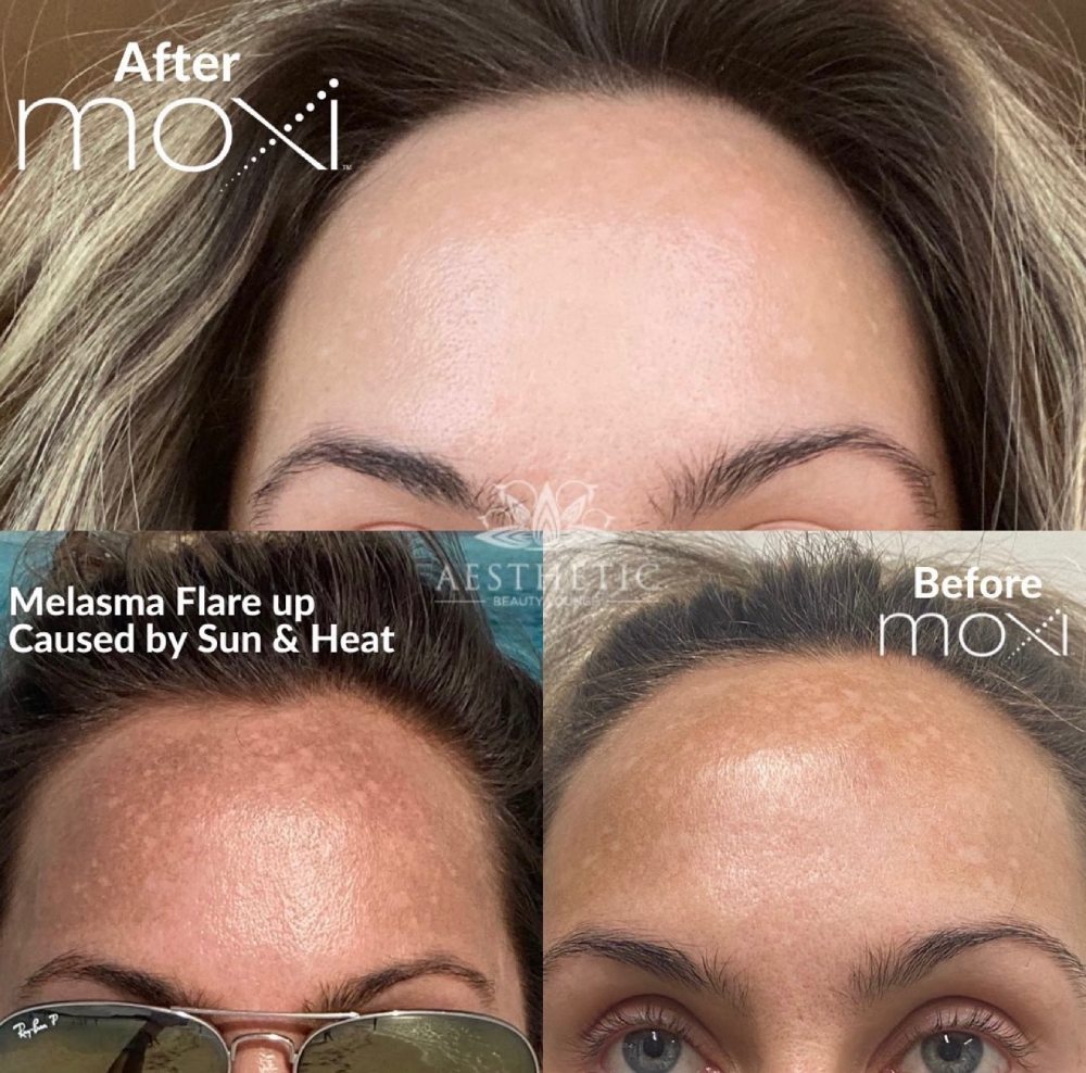 Moxi Before & After Image