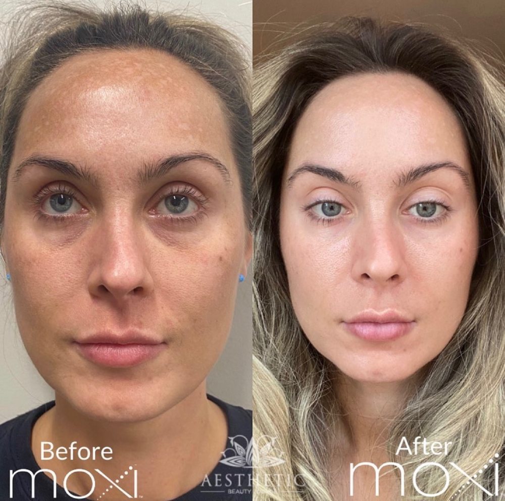 Moxi Before & After Image